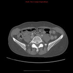 Veine rénale gauche circumaortique TDM Abdomen Axial Temps veineux Veine rénale gauche circumaortique TDM Abdomen Axial Temps veineux