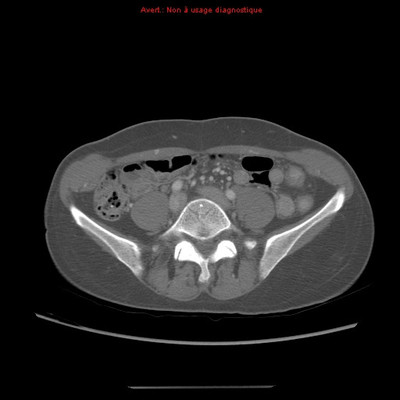 Veine rénale gauche circumaortique  TDM Abdomen Axial Temps veineux