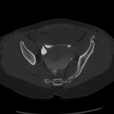 Abdominal vessels trauma, Intraperitoneal bladder rupture, Spleen infarction, Pelvic fracture Pelvic CT, Axial plane, Bone window