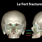 Fractures of skull lefort-fracture-skull-classification Fractures of skull lefort-fracture-skull-classification