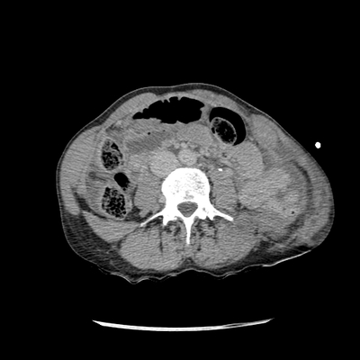 Traumatic perforation of small intestine, fracture of lumbar vertebra Abdomen CT, Delayed phase, Axial plane