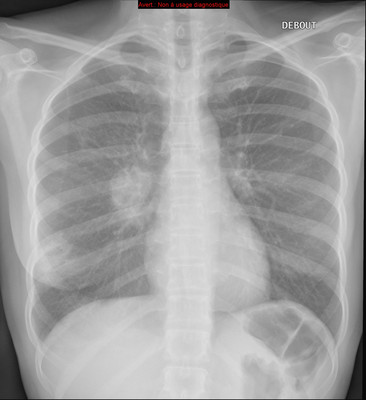 Adénocarcinome pulmonaire avec contingent à cellules claires Radiographie Thorax