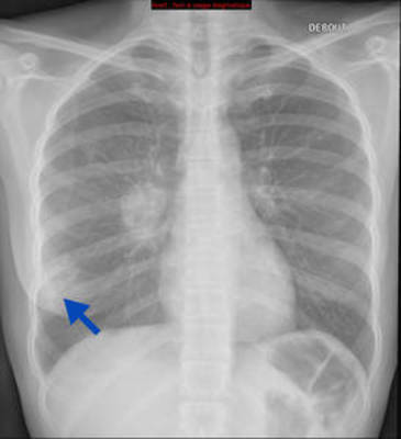 Adénocarcinome pulmonaire avec contingent à cellules claires Radiographie Thorax