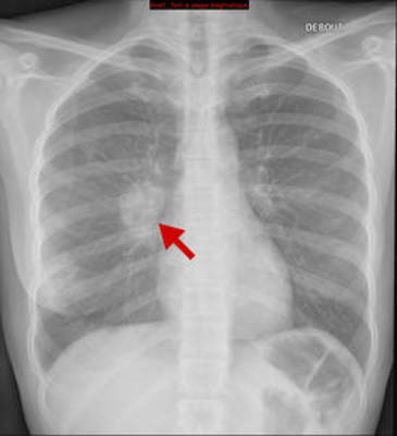 Adénocarcinome pulmonaire avec contingent à cellules claires Radiographie Thorax