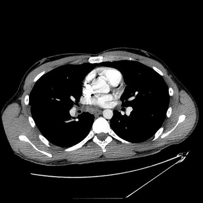 Pneumopathie infectieuse de la base droite Axial Médiastin