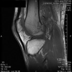 Lésion du point d'angle postéro externe - Rupture du LCA et du LCP Sagittal T1 Lésion du point d'angle postéro externe - Rupture du LCA et du LCP Sagittal T1