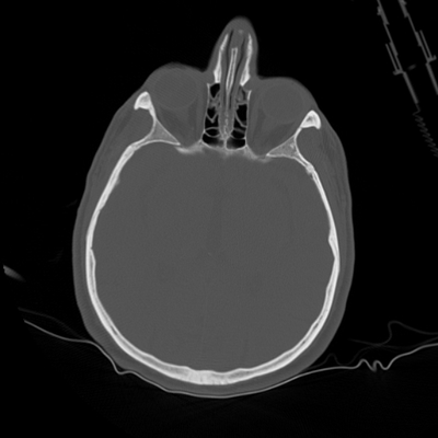 Occipital Condyle Fracture, Thoracic injuries, Hepatic trauma, Adrenal hemorrhage Head CT, Axial plane, Bone window