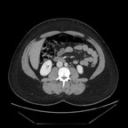Appendicite aiguë non compliquée Axial portal Appendicite aiguë non compliquée Axial portal