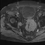 Cancer rectal classé T4 N2 IRM Pelvis Axial T1 Fat sat gadolinium Cancer rectal classé T4 N2 IRM Pelvis Axial T1 Fat sat gadolinium