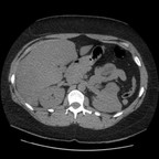 Phéochromocytome bilatéral, tumeurs rénales et kystes rénaux dans le cadre d'une maladie de Von Hippel Lindau TDM sans injection Phéochromocytome bilatéral, tumeurs rénales et kystes rénaux dans le cadre d'une maladie de Von Hippel Lindau TDM sans injection