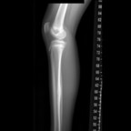 Ostéome ostéoïde cortical postérieur du tibia droit Radiogrpahie jambe droite de profil Ostéome ostéoïde cortical postérieur du tibia droit Radiogrpahie jambe droite de profil