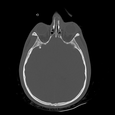 Cranioencephalic trauma, Facial fracture, Thoracic injuries, Pelvic fracture, Spleen and renal trauma Head CT, Axial plane, Bone window