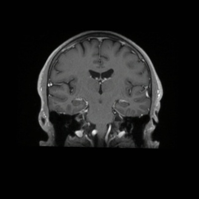 Schwannome cochléovestibulaire (neurinome de l'acoustique) T1 3D GADO AXIAL_MPR_Cor
