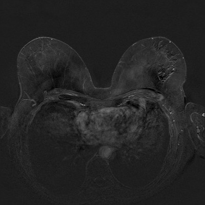 Asymétrie mammaire avec petit nodule dont l’aspect est en faveur d’un fibroadénome au sein d'un tissu glandulaire plus dense à droite. Soustraction 3 min