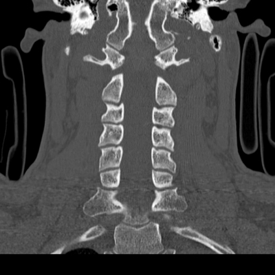 Traumatic diaphragmatic rupture, Thoracic and abdominal injuries, burst vertebral fracture, foot injuries Cervical spine, Coronal plane, Bone window