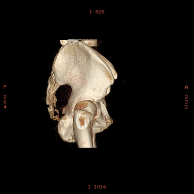 Thoracic Injuries, Subcapsular hemorrhage of liver, Pelvic injury Pelvis, 3D VR