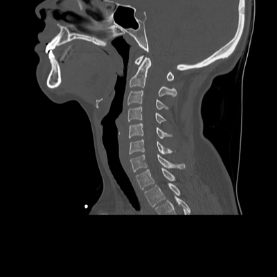 Abdominal vessels trauma, Intraperitoneal bladder rupture, Spleen infarction, Pelvic fracture Cervical spine, Sagittal plane, Bone window