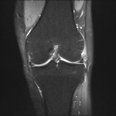 Anévrysme poplité thrombosé DP FS Coronal