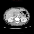 Tuberculose multiviscérale avec atteinte ganglionnaire, pleurale et hépatosplénique TDM Abdomen Axial Fenêtre Tissus mous Tuberculose multiviscérale avec atteinte ganglionnaire, pleurale et hépatosplénique TDM Abdomen Axial Fenêtre Tissus mous