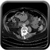 Occlusion mécanique du grêle avec souffrance digestive Axial sans injection