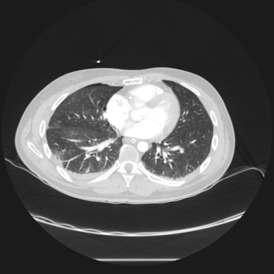 Occipital Condyle Fracture, Thoracic injuries, Hepatic trauma, Adrenal hemorrhage Chest CT, Lung window, Axial plane
