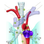Thoracic lymph node map - IASLC 2009 thoracic-lymph-node-map-iaslc-2009 Thoracic lymph node map - IASLC 2009 thoracic-lymph-node-map-iaslc-2009