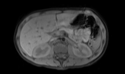 Phéochromocytome et paragangliome dans un contexte de maladie de Von Hippel Lindau ser008img00001