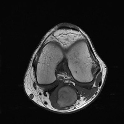Anévrysme poplité thrombosé Axial T1 Gadolinium
