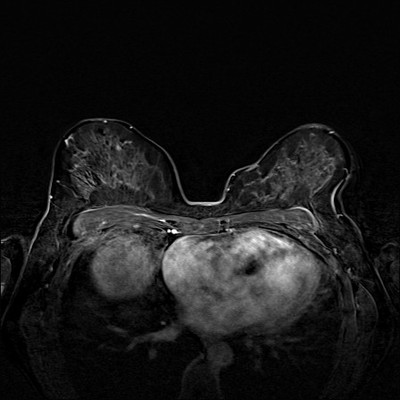 Carcinome canalaire in situ supéro-médian droit Soustraction 4 min