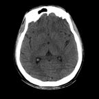 Renal vein rupture, Adrenal hemorrhage Head CT, Axial plane, Soft tissue window Renal vein rupture, Adrenal hemorrhage Head CT, Axial plane, Soft tissue window