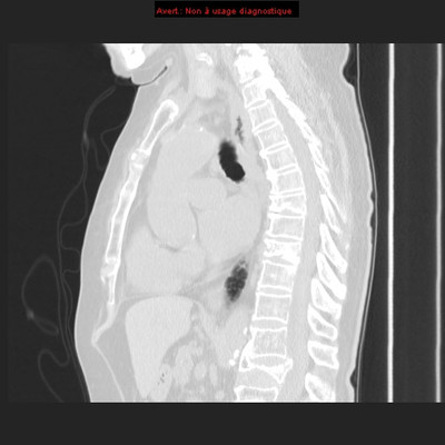 Pneumopathie interstitielle fibrosante à la cordarone  TDM Thorax Sagittal
