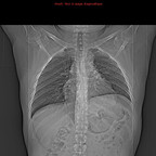 Tumeur maligne médiastinale antérieure (thymome B3) et myasthénie Radiographie Thorax Tumeur maligne médiastinale antérieure (thymome B3) et myasthénie Radiographie Thorax