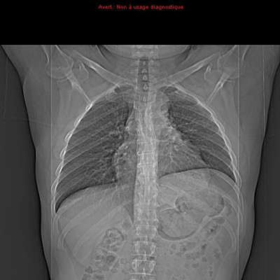 Tumeur maligne médiastinale antérieure (thymome B3) et myasthénie  Radiographie Thorax