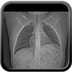 Tumeur maligne médiastinale antérieure (thymome B3) et myasthénie  Radiographie Thorax