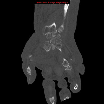 Chondrocalcinose  TDM Membre supérieur Coronal