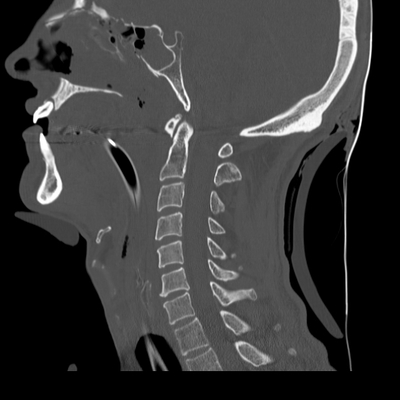 Severe cranioencephalic injuries, Carotid artery dissection, Aspiration pneumonia, Pelvic fracture Cervical spine, Sagittal plane, Bone window