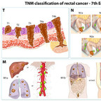 Colorectal cancer staging TNM-rectum-cancer-staging Colorectal cancer staging TNM-rectum-cancer-staging