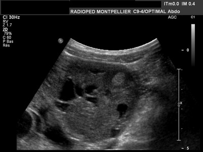 Tumeur Juvénile De l.  A. Granulosa