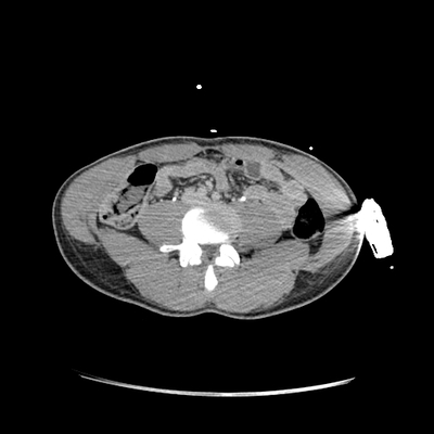 Cranioencephalic injuries, limb injuries, aspiration pneumonia Abdomen CT, Delayed phase, Axial plane