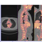 Adénocarcinome colique sigmoïdien métastatique TEP images significatives et reconstructions Adénocarcinome colique sigmoïdien métastatique TEP images significatives et reconstructions