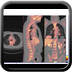 Adénocarcinome colique sigmoïdien métastatique  TEP images significatives et reconstructions