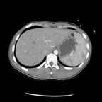 Fracture de Chance de L2 avec luxation articulaire postérieure L2-L3 gauche TAP Axial Artériel Fracture de Chance de L2 avec luxation articulaire postérieure L2-L3 gauche TAP Axial Artériel