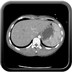 Fracture de Chance de L2 avec luxation articulaire postérieure L2-L3 gauche TAP Axial Artériel