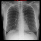 Lymphangioleiomyomatose pulmonaire Radiographie Thorax Face Lymphangioleiomyomatose pulmonaire Radiographie Thorax Face