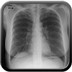 Lymphangioleiomyomatose pulmonaire  Radiographie Thorax Face