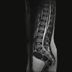 Lipome spinal intradural lombaire T2 TSE SAG Lipome spinal intradural lombaire T2 TSE SAG