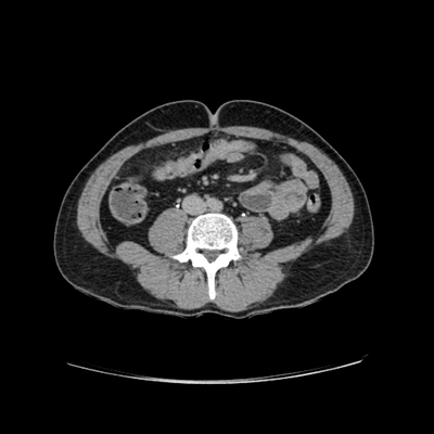 Occipital Condyle Fracture, Thoracic injuries, Hepatic trauma, Adrenal hemorrhage Abdomen CT, Delayed phase, Axial plane