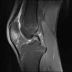Fracture parcellaire de la patella avec contusion osseuse DP FS Sagittal Fracture parcellaire de la patella avec contusion osseuse DP FS Sagittal