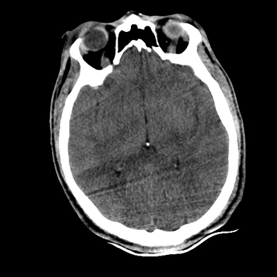 Cranioencephalic injuries, limb injuries, aspiration pneumonia Head CT, Axial plane, Soft tissue window