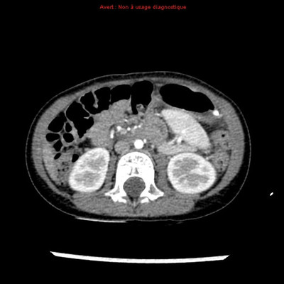 Volvulus gastrique associé à une rate oscillante TDM abdomino-pelvienne (axial)